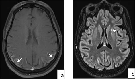 Case 4 Axial T1 Brain Mri With Gadolinium Injection Identifying A