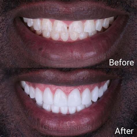 Same Day Veneers In Coral Gables Ismile Gables