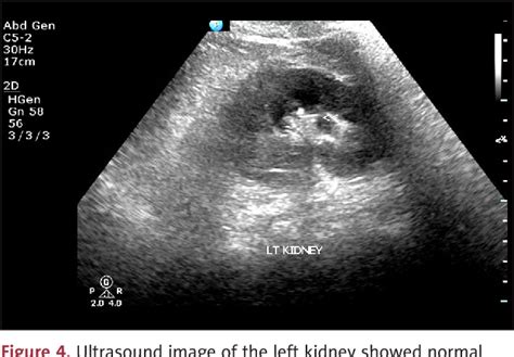 Figure From Treatment Of Renal Fungal Ball With Fluconazole