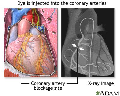 Coronary Artery Balloon Angioplasty Seriesprocedure Part