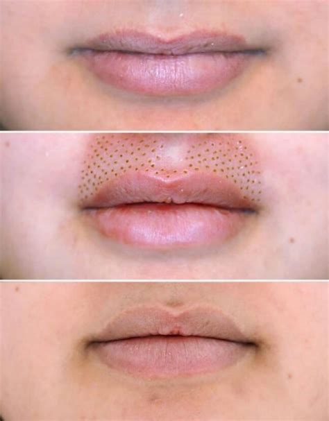 Lip Flip Augmentation For Lasting Fuller More Pouty Look By Plasma