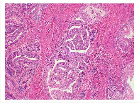 Invasive Endometrial Adenocarcinoma Showing Similar Cytologic Features