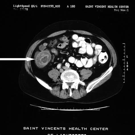 Computed Tomographic Scan Demonstrating The Target Sign In An Ileocecal Download Scientific