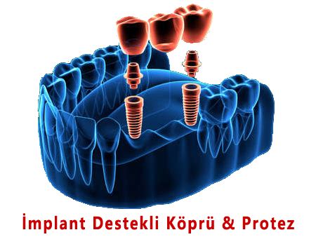 Ankara Mplant Tedavisi Mplant Fiyatlar Di Hekimi Ankara