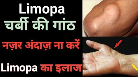 गठ Lipoma ka ilaaj charbi ki ganth ka ilaaj Lipoma Ayurvedic