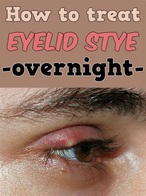 How To Remove A Stye From Your Eyelid