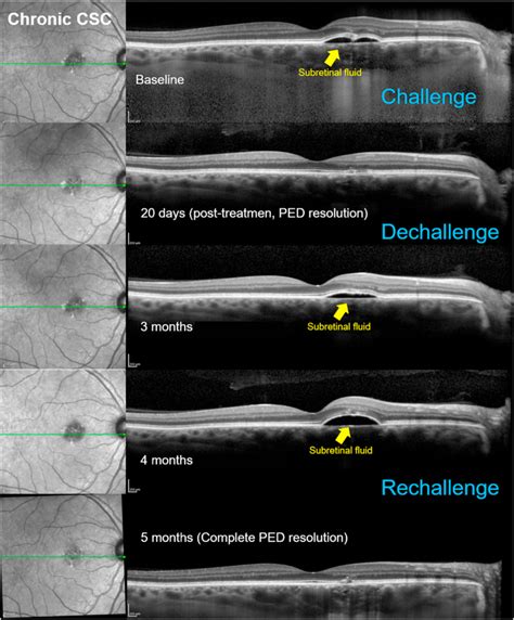 Central Serous Chorioretinopathy Treatment With A Systemic PDE5 And