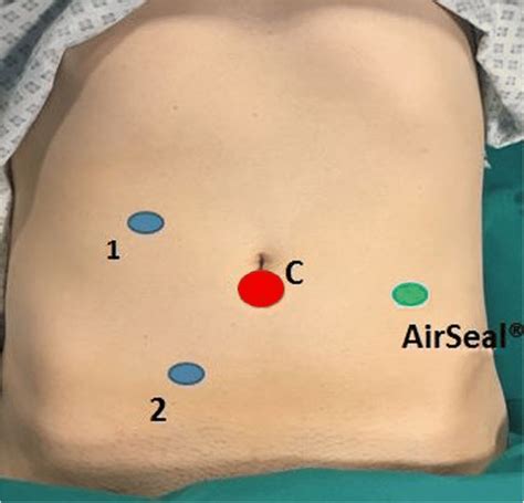 Trocar Sites For Laparoscopic Splenic Flexure Sf Resection C