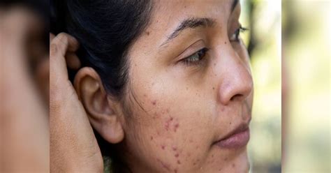 Blemishes Will Disappear From Face In 3 Weeks Try These Home Remedies 3 सप्ताह में चेहरे से