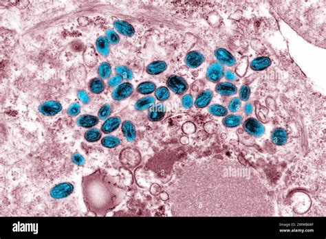 Variola virus hi-res stock photography and images - Alamy