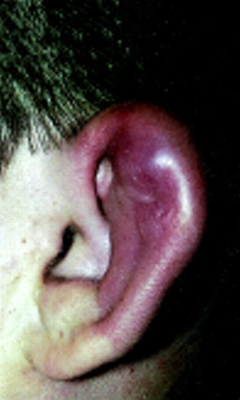 Perichondritis A Complication Of Piercing Auricular Cartilage