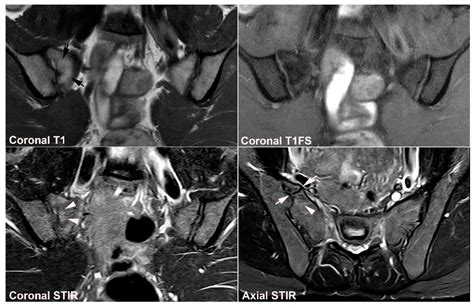 Jcm Free Full Text Diagnostics Of Sacroiliac Joint Differentials To Axial Spondyloarthritis