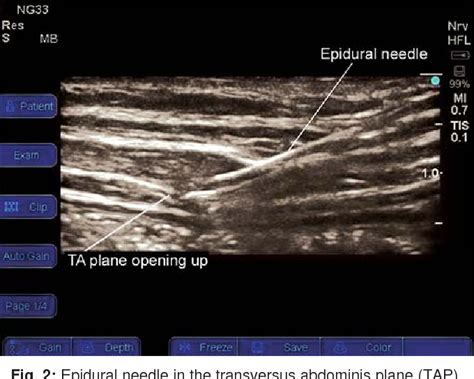 Posterior Transversus Abdominis Plane TAP Catheters In Lower