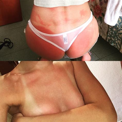 Do Burn Lines Count First Day On Holiday Porn Pic
