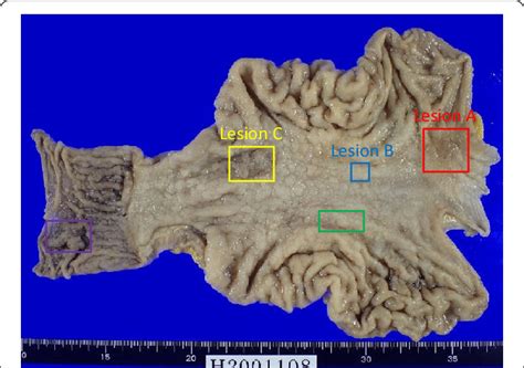 The Resected Specimen Of The Stomach And Proximal Duodenum The Red Download Scientific