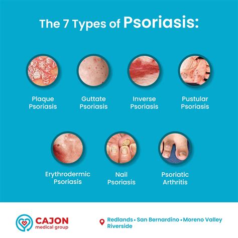 🔴plaque Psoriasis Is The Most Common Cajon Medical Group