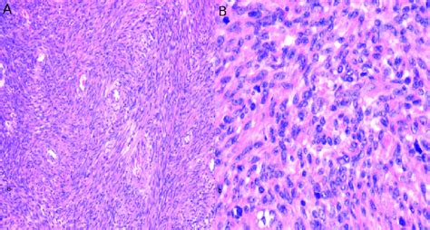 A Interlacing Fascicles Of Spindle Cells H E B Elongated