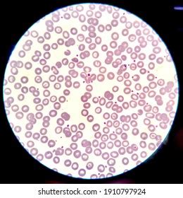 Peripheral Blood Smear Target Cells Microcytes Stock Photo 1910797924 ...