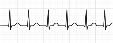Av Nodal Reentrant Tachycardia Tachyarrhythmias Medschool