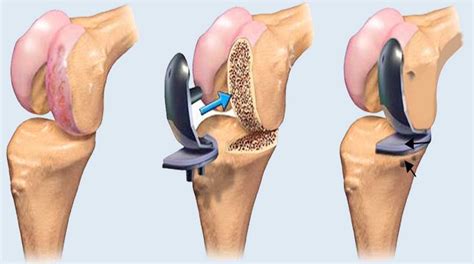 Understanding Knee Replacement Surgery What To Expect Before During