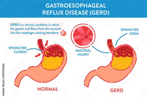 Gastroesophageal Reflux Disease Infographic Banner Endoscopic Image Of Esophagus After Acid