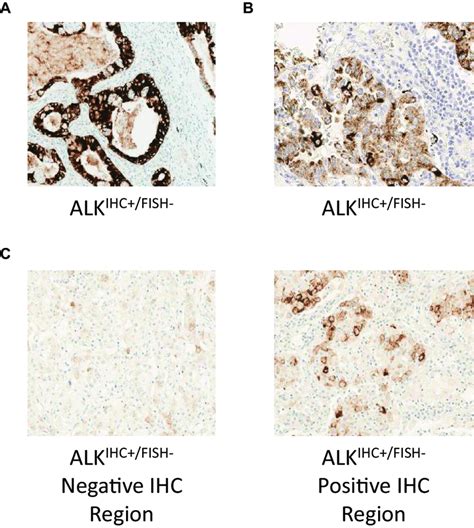 Patterns Of Anaplastic Lymphoma Kinase Alk Immunohistochemistry Ihc