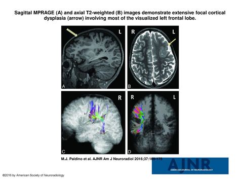 Sagittal Mprage A And Axial T Weighted B Images Demonstrate