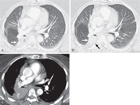 Radiation Fibrosis Lung Radiopaedia
