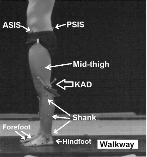 Figure 1 From Femoroacetabular Impingement Syndrome Is Associated With