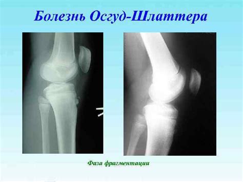 Болезнь Осгуда Шлаттера: у подростков, взрослых и детей, лечение