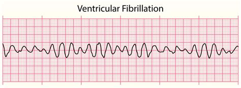 Ventricular Fibrillation Images Browse 5146 Stock Photos Vectors