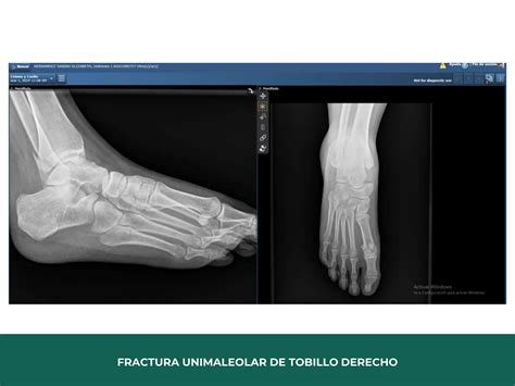 CENSO RADIOGRAFICO Con Manejo De Principios Biomecanicos Pptx