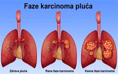 Genetska Predispozicija Nije Jedini Faktor Koji Pove Ava Rizik Od Raka