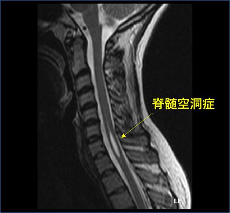 【キアリ奇形・脊髄空洞症とは？】発見から手術までの体験記と現在の状態 | ライフレシピ