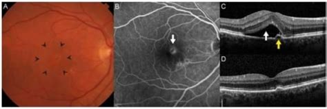 Degeneraci N Macular Concise Medical Knowledge