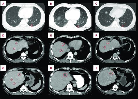 Thoracic And Abdominal Contrast Enhanced Computed Tomography Ct Scans