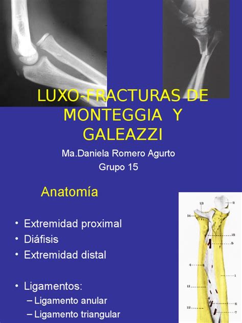 Fractura Monteggia Galeazzi Elbow Joints