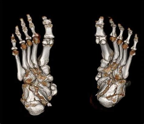 Bone Ct Don Juan S Fracture Radrounds Radiology Network