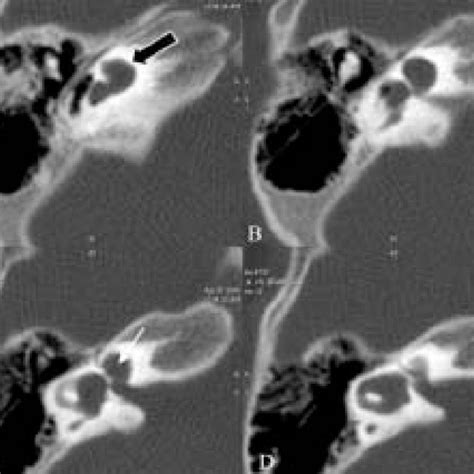 Pdf Pictorial Review Of Mri Ct Scan In Congenital Temporal Bone