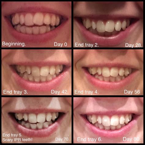 Progress So Far Day 0 To Day 80 R Invisalign