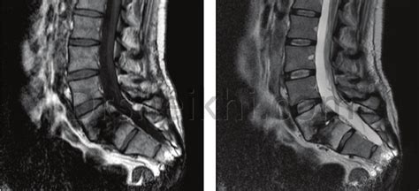 تشخیص دیسک کمر از روی Mri دکتر علیرضا شیخی دکتر علیرضا شیخی