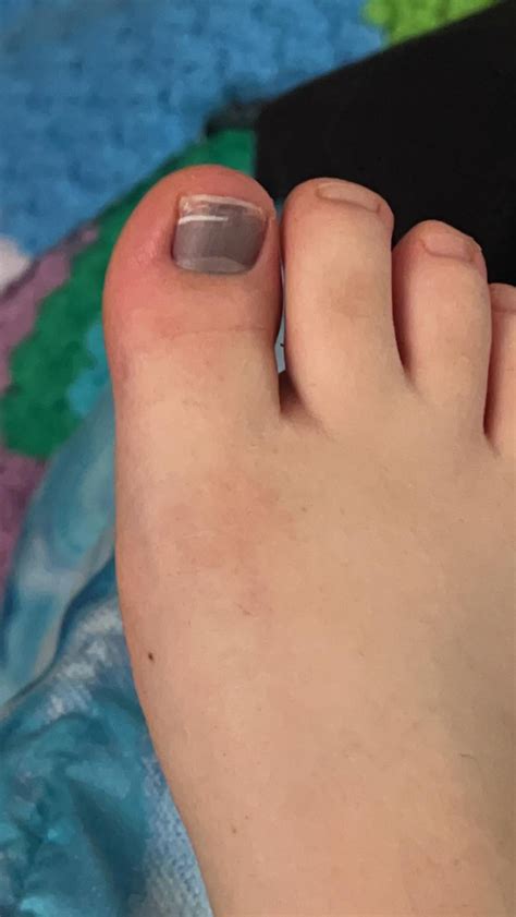 Toenail Falling Off Rmedical