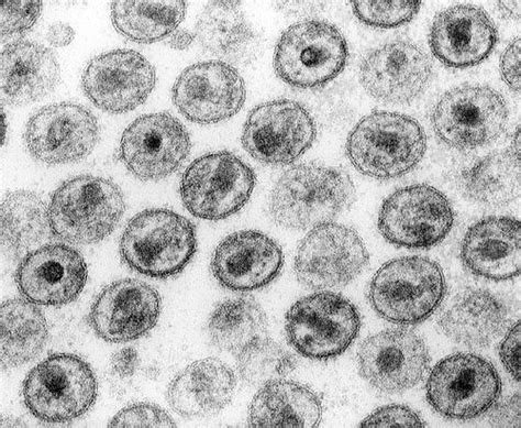 denialisme hivaids wikipedia bahasa indonesia ensiklopedia bebas