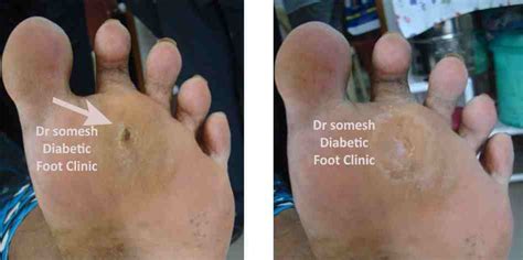 Diabetic Foot Ulcer Stages