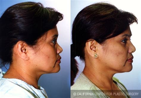 Patient Asian Rhinoplasty Before And After Photos Encino