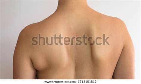 Scoliosis Curved Naked Back Caucasian Woman Stock Photo 1713101812 Shutterstock