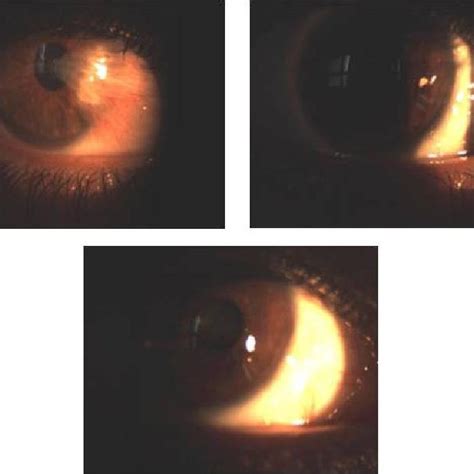 Recurrent Pterygium Download Scientific Diagram