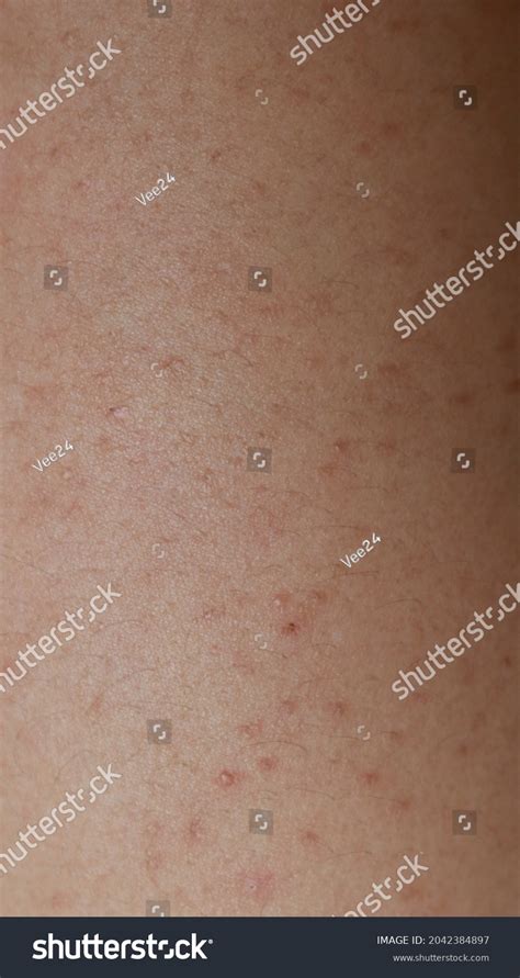 skin rash extensive red rashes  stock photo  shutterstock