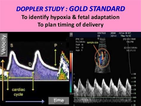 Ultrasound Tips On Fetal Growth Restriction On 29th January 2018