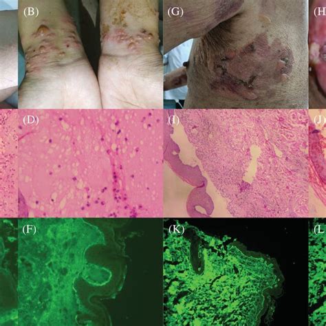 (A,B) Blisters, (C) subepidermal bulla (original magnification ×40 ...